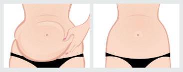 dermolipectomia_abdomen