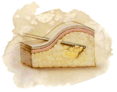 lipoaspiracao-fig1