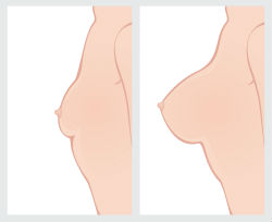 mamoplastia_aumento