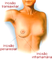 Mamoplastia de aumento