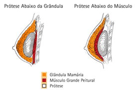 Mamoplastia de aumento