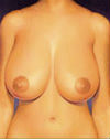 Mamoplastia Redutora