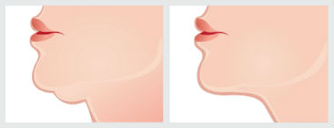 mentoplastia