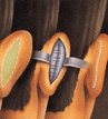 Otoplastia