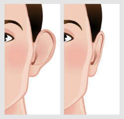 otoplastia
