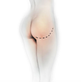 protese_glutea