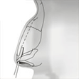 rinoplastia-fig1
