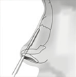 rinoplastia-fig1