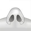 rinoplastia-fig1