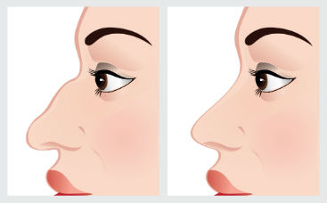 rinoplastia