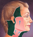 Ritidoplastia