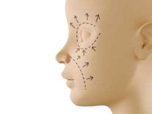 ritidoplastia