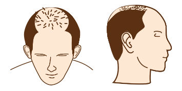 transplante_capilar